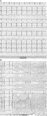 Arrhythmia and/or Cardiomyopathy Related to Maternal Autoantibodies: Descriptive Analysis of a Series of 16 Cases From a Single Center